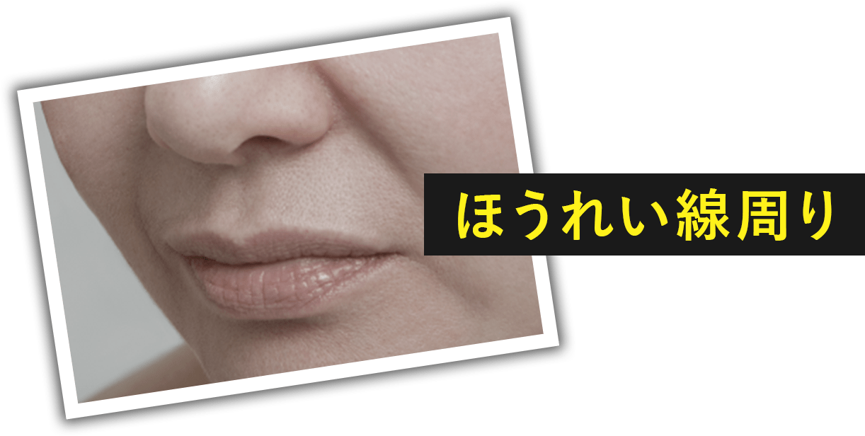 ほうれい線周り